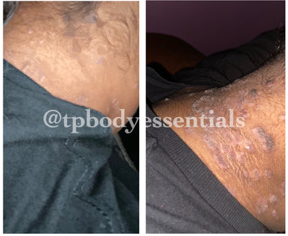 Restore & Renew Body Butter (For Eczema, Scars, Blemishes)