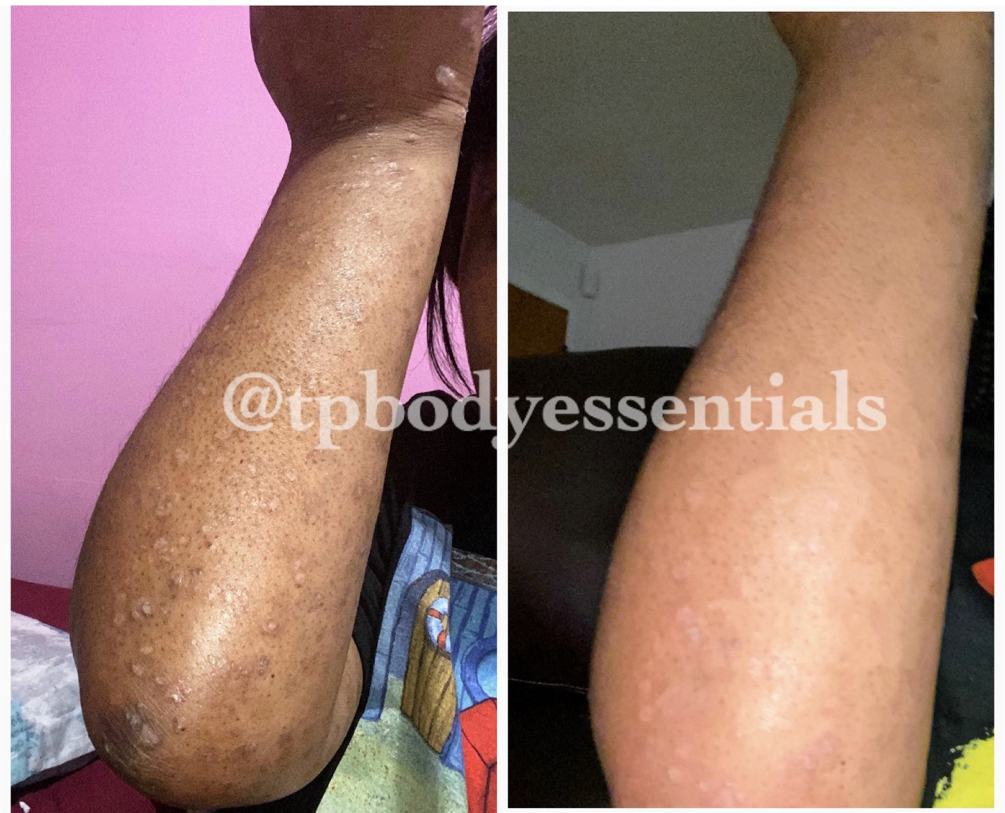 Restore & Renew Body Butter (For Eczema, Scars, Blemishes)