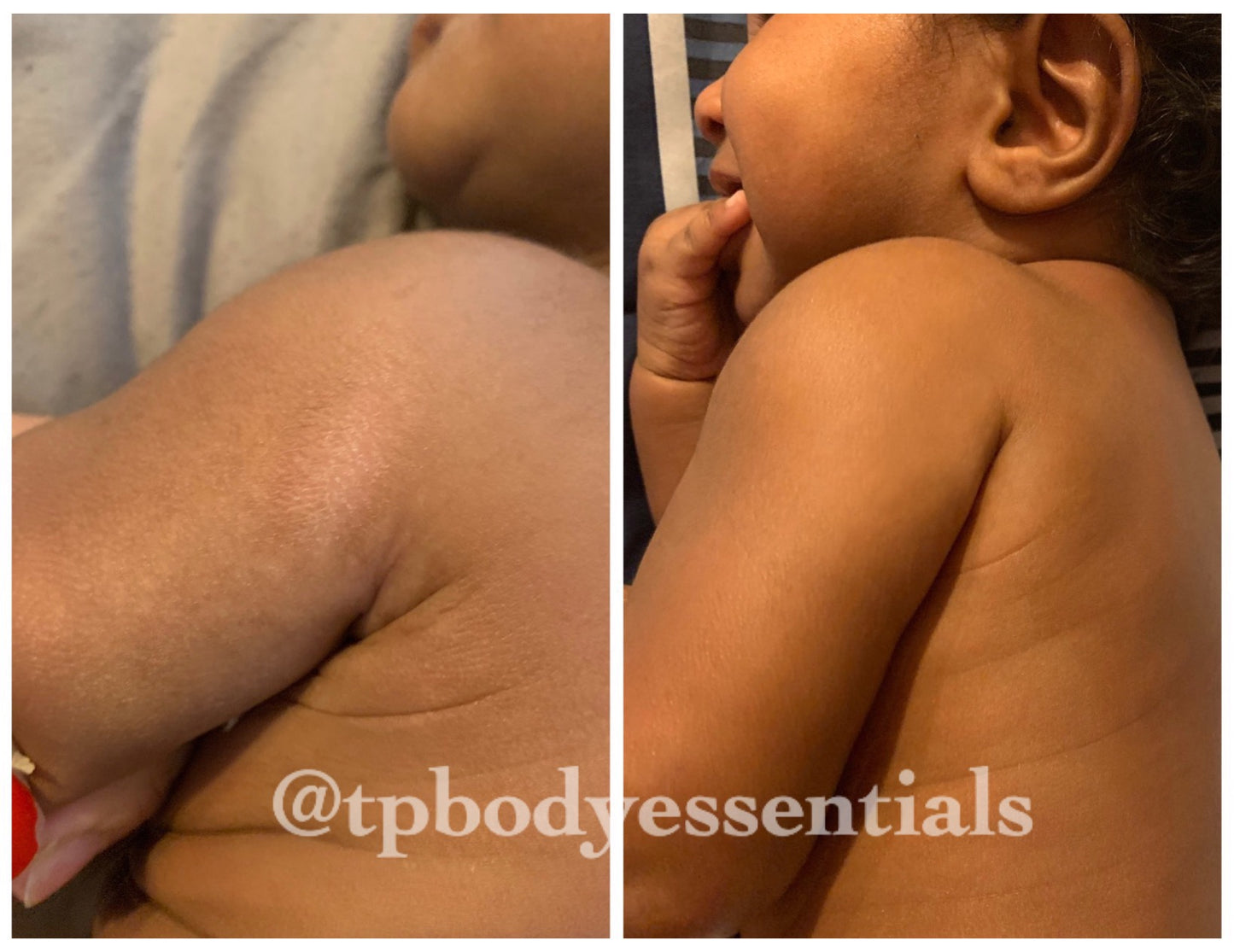 Restore & Renew Body Butter (For Eczema, Scars, Blemishes)