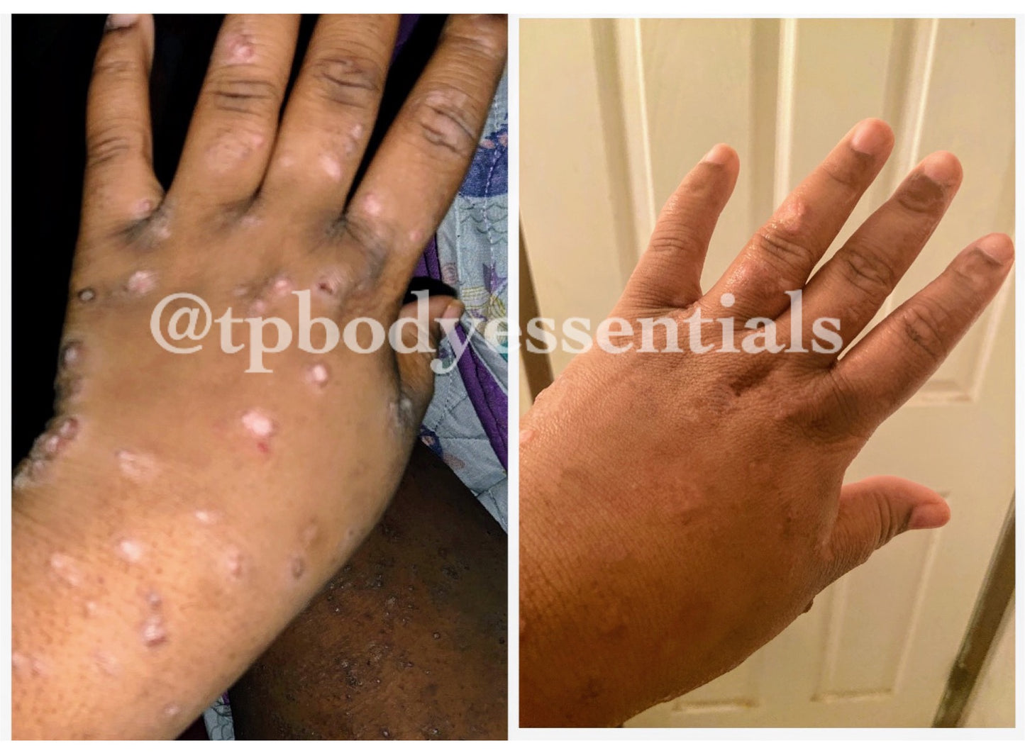 Restore & Renew Body Butter (For Eczema, Scars, Blemishes)